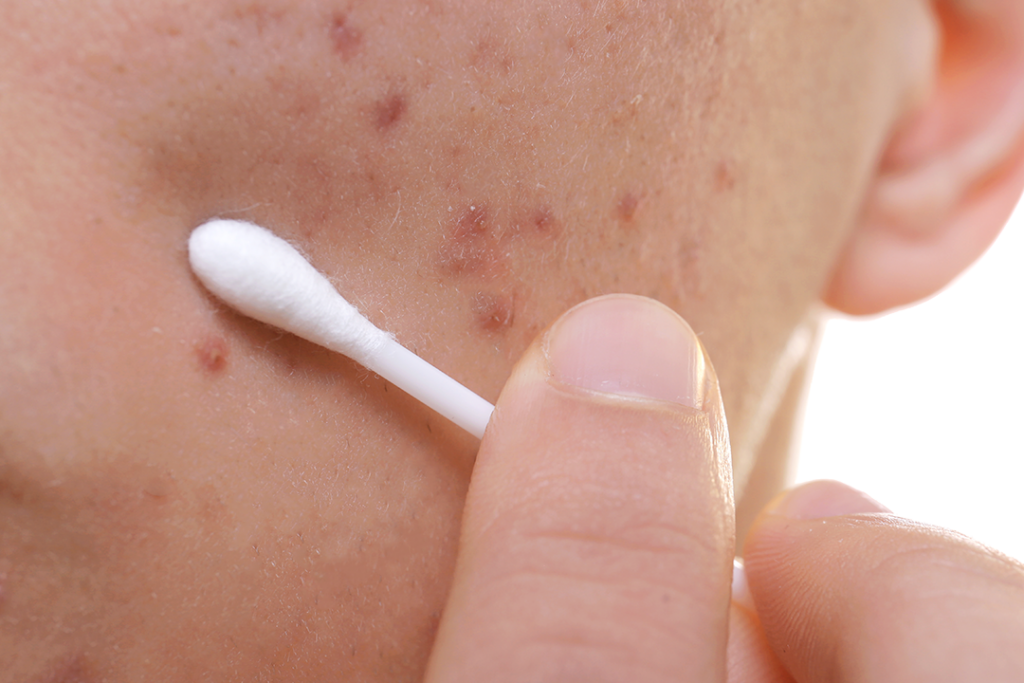 면봉을 사용하여 고민 부위에만 위생적으로 연고를 바르는 모습