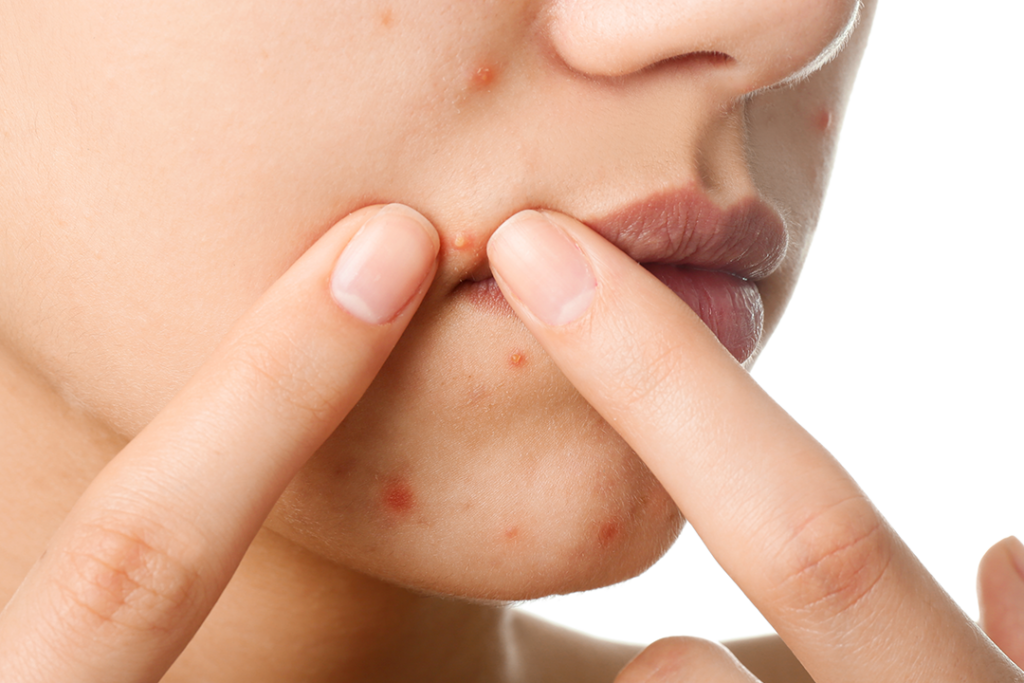 여드름 관리를 위해 손가락으로 좁쌀 여드름을 직접 압출하려고 시도하는 위험한 행동