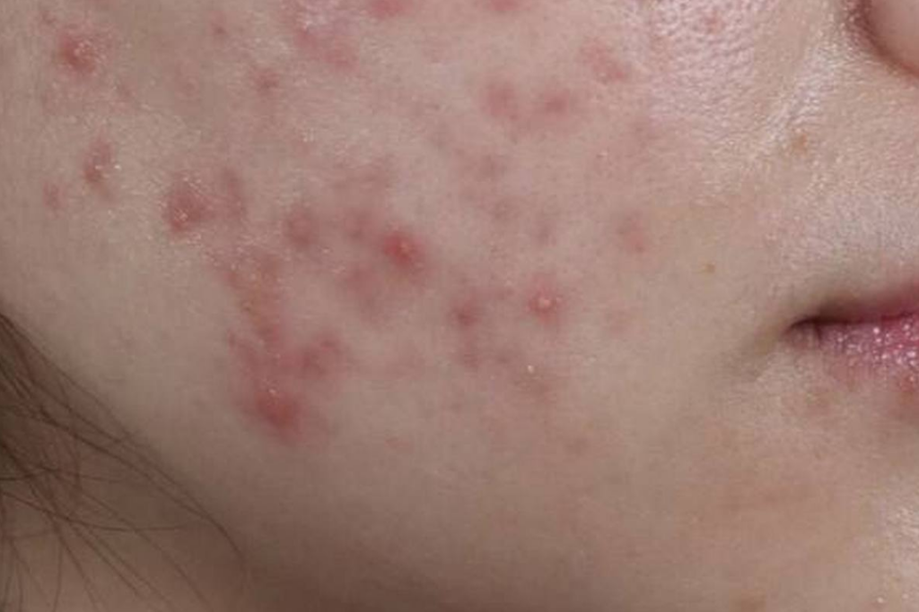 반복되는 트러블과 붉은 흔적으로 여드름 흉터 없애는법이 절실한 피부 상태