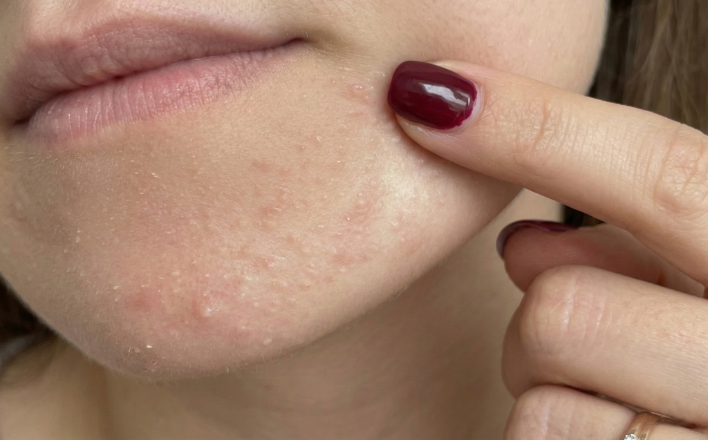 손가락으로 턱 주변의 오돌토돌한 좁쌀여드름과 피지 요철 부위를 가리키는 모습