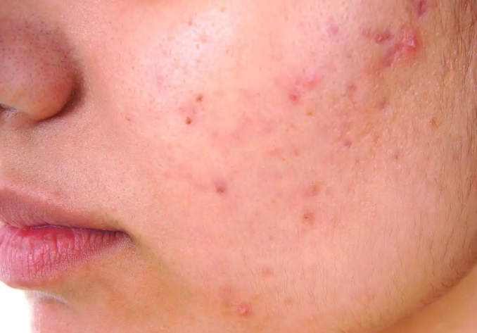 얼굴 부위별 여드름 원인  볼과 턱 주변에 붉은 트러블이 올라온 성인 여드름 피부 클로즈업