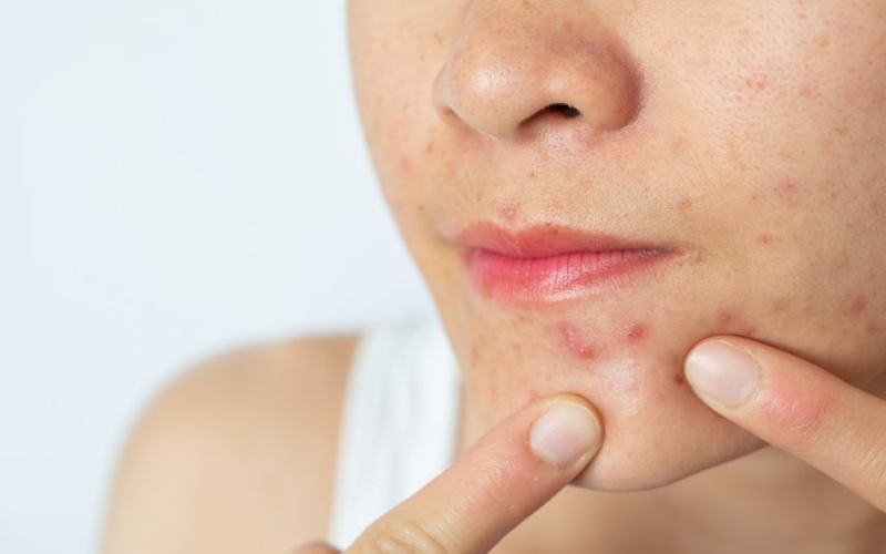 생리 주기 호르몬 변화로 생긴 턱 여드름 부위를 손으로 만지고 있는 성인 여성 사진