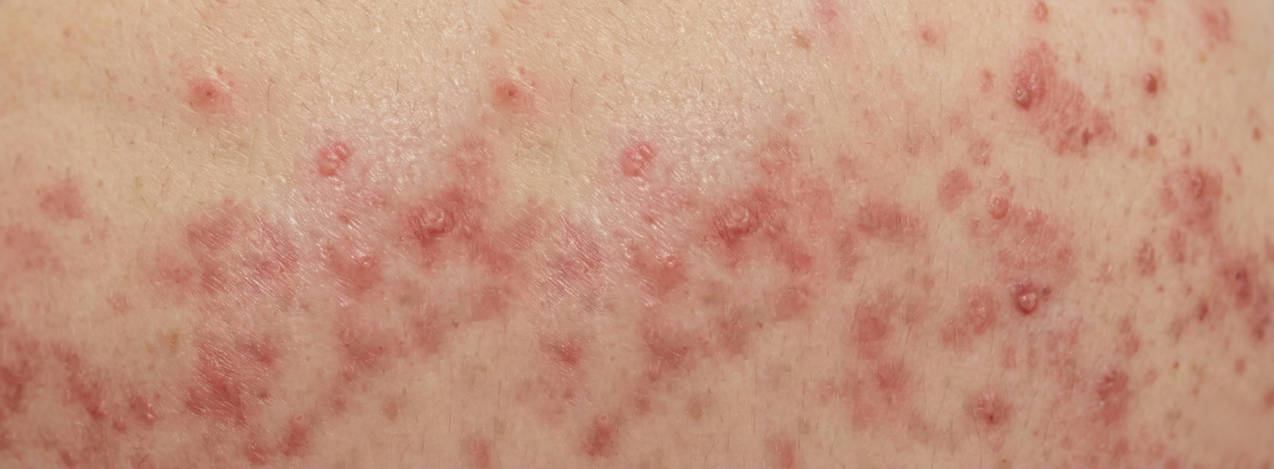 모낭염 여드름 구분하는 법 – 모낭염 증상 피부 사진