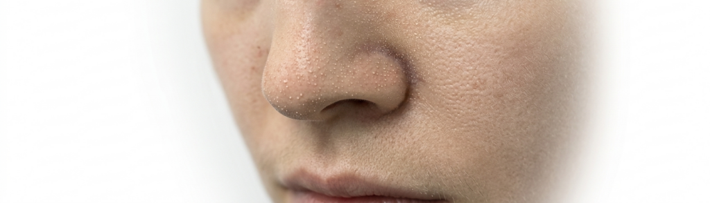 코 모공 피지 좁쌀 클로즈업 — 모공피지제거 전 피부 상태