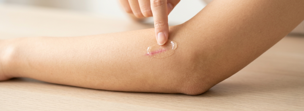 팔 흉터 부위에 투명 겔 약국 흉터 연고 바르는 모습 메디리턴겔 사용감