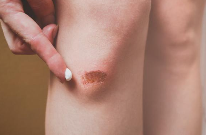 무릎 찰과상 상처에 흉터 연고 바르는 모습 약국 흉터 연고 사용법